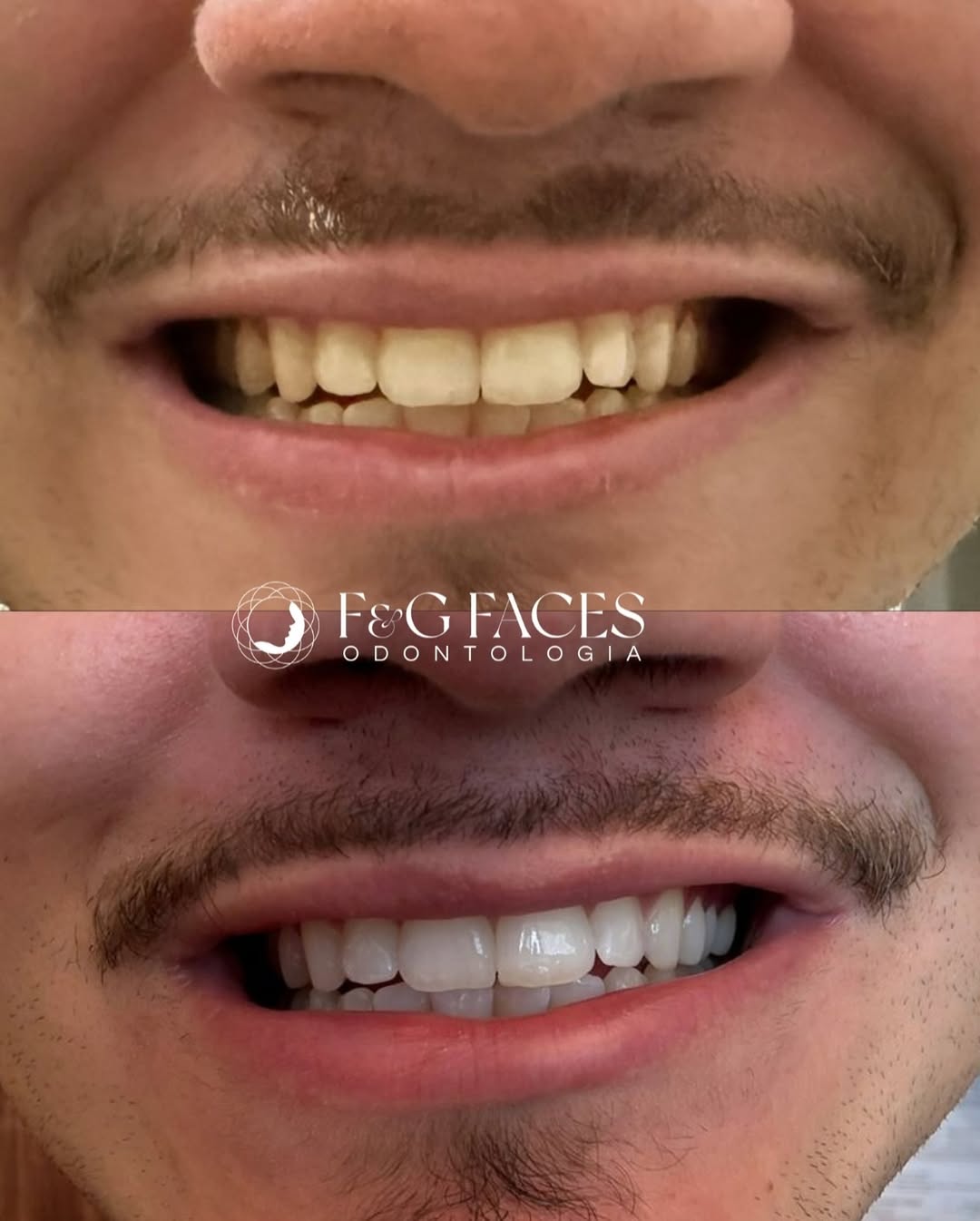 CLAREAMENTO DENTAL