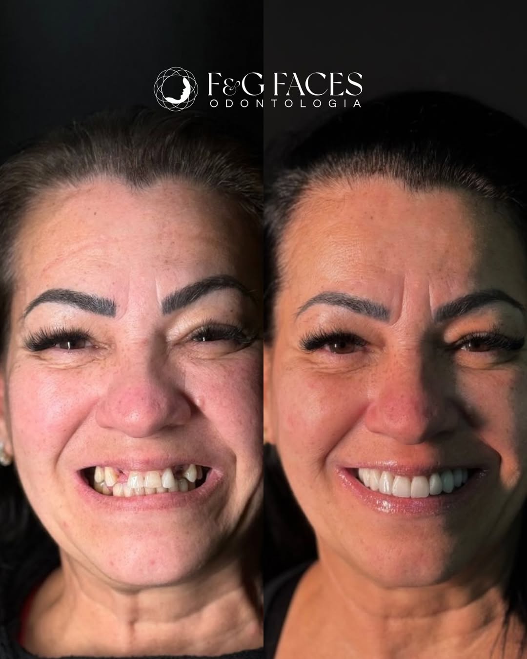 IMPLANTES DENTAL