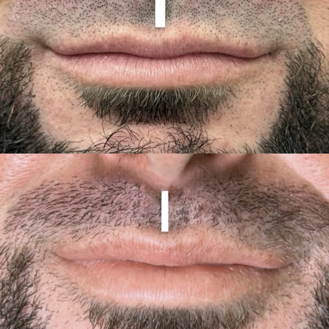 LIPLIFT