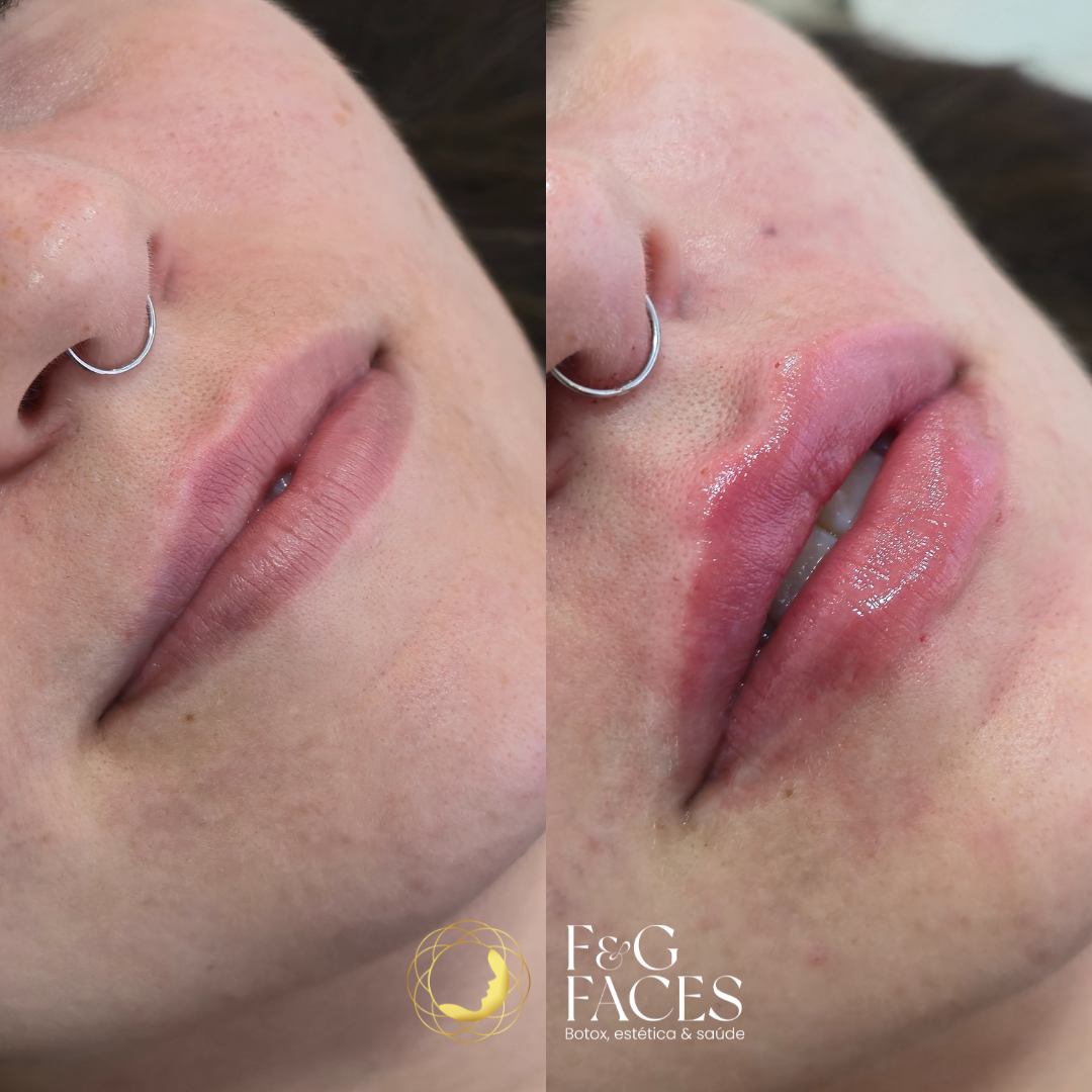 PREENCHIMENTO LABIAL